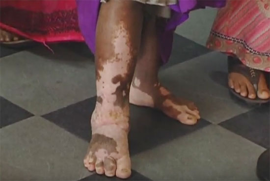 Live Healing miracle. Rotten, infected and maggot-infested leg healed after 10 years. Miracle by applying the Healing oil of Grace Ministry in Mangalore.   